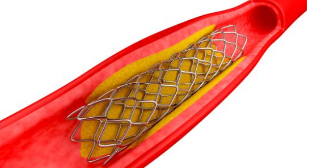 低温豆奶视频免费观看在线技术对心血管支架药物涂层均匀性和牢固度提升-豆奶视频在线观看豆奶视频APP官网机